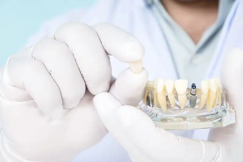 an implant dentist holding a dental implant crown and model.an implant dentist holding a dental implant crown and model.